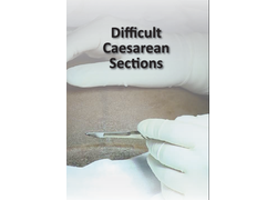 Difficult Caesarean Sections